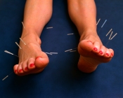 acupuncture_needles_sticking Out from Feet